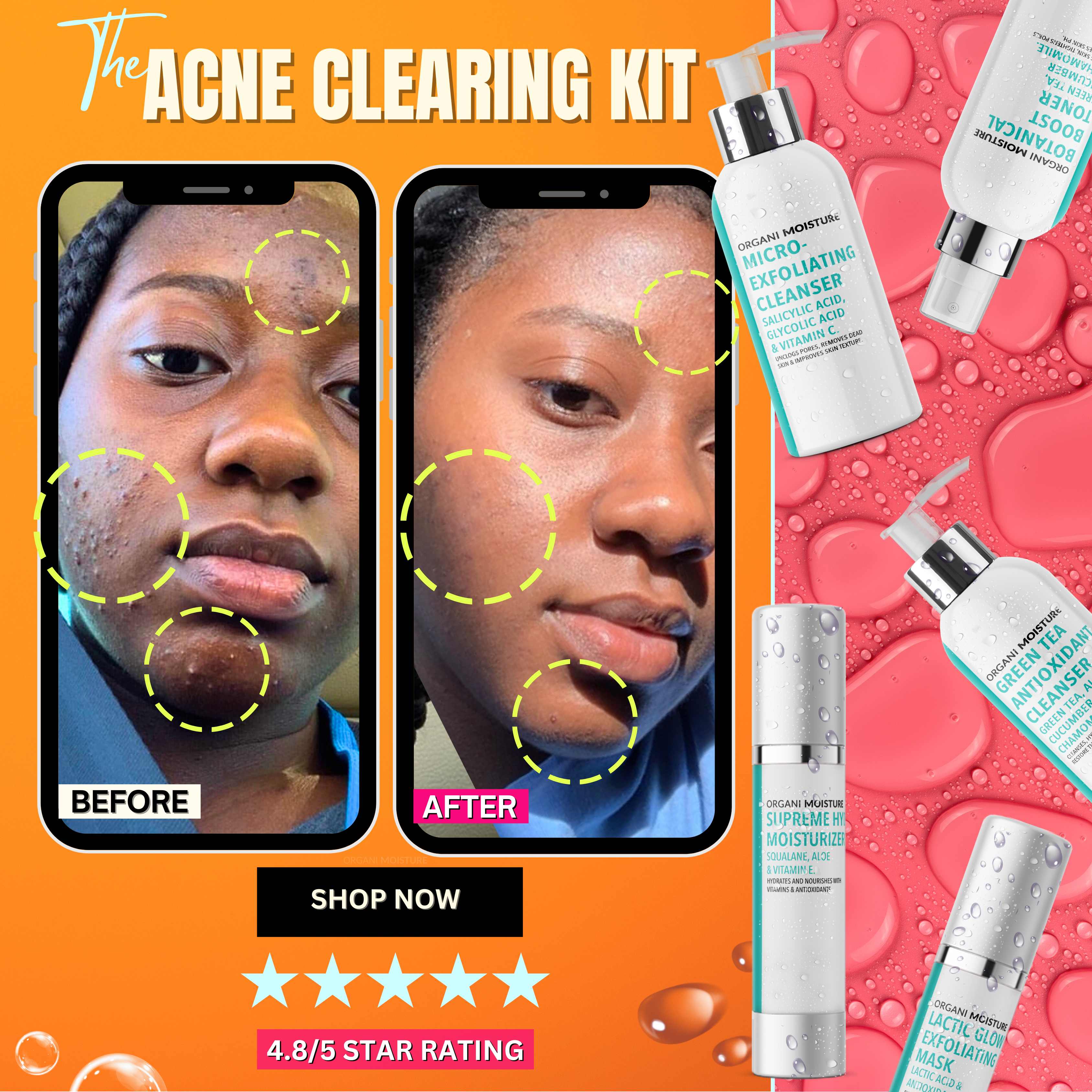 Acne_Clearing_Kit_Mobile_Banner_1.png